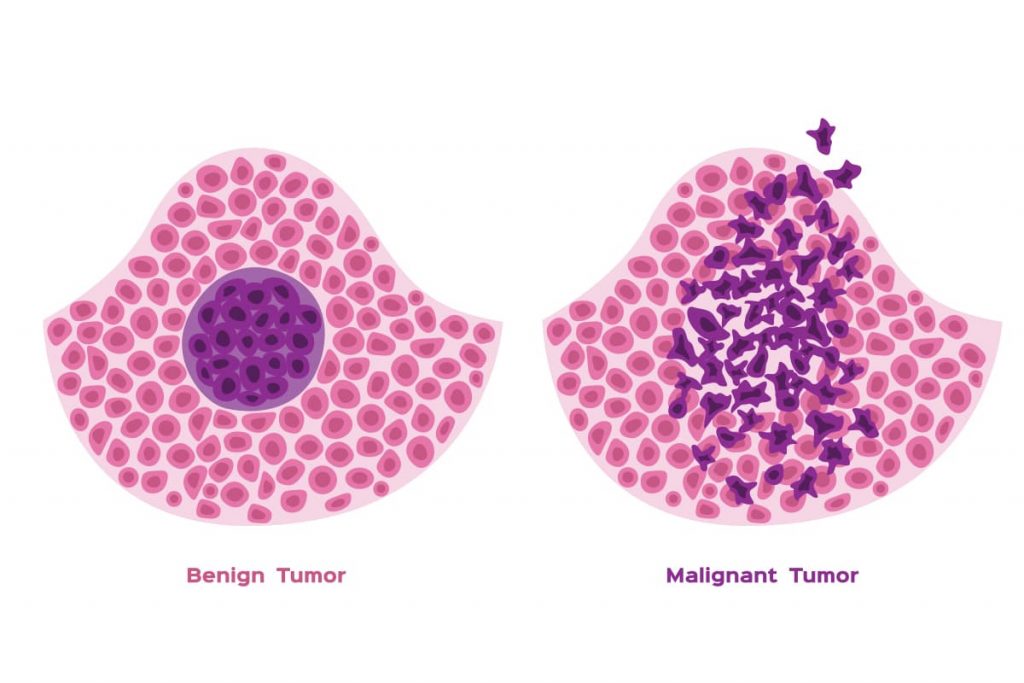 Benign vs Malignant tumor